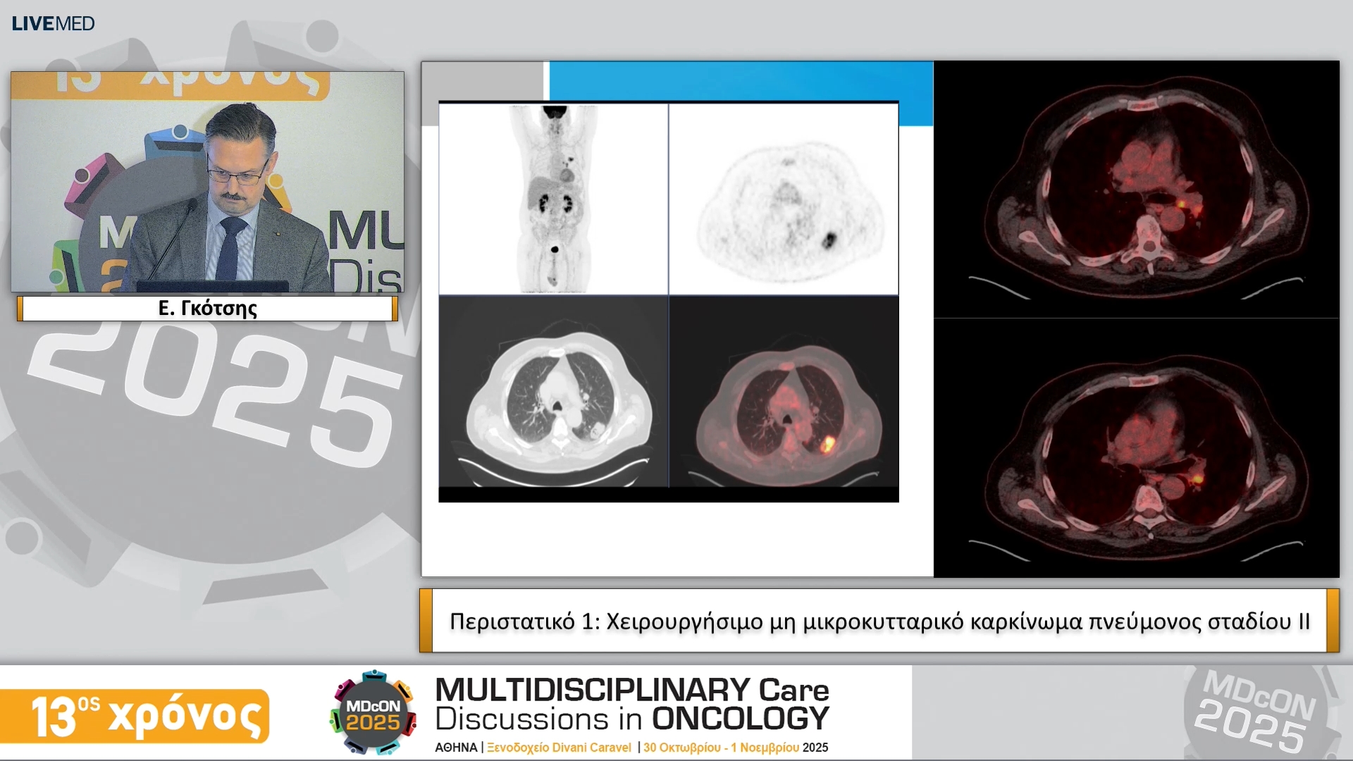 11 Ε. Γκότσης • Περιστατικό 1: Χειρουργήσιμο μη μικροκυτταρικό καρκίνωμα πνεύμονος σταδίου ΙΙ 