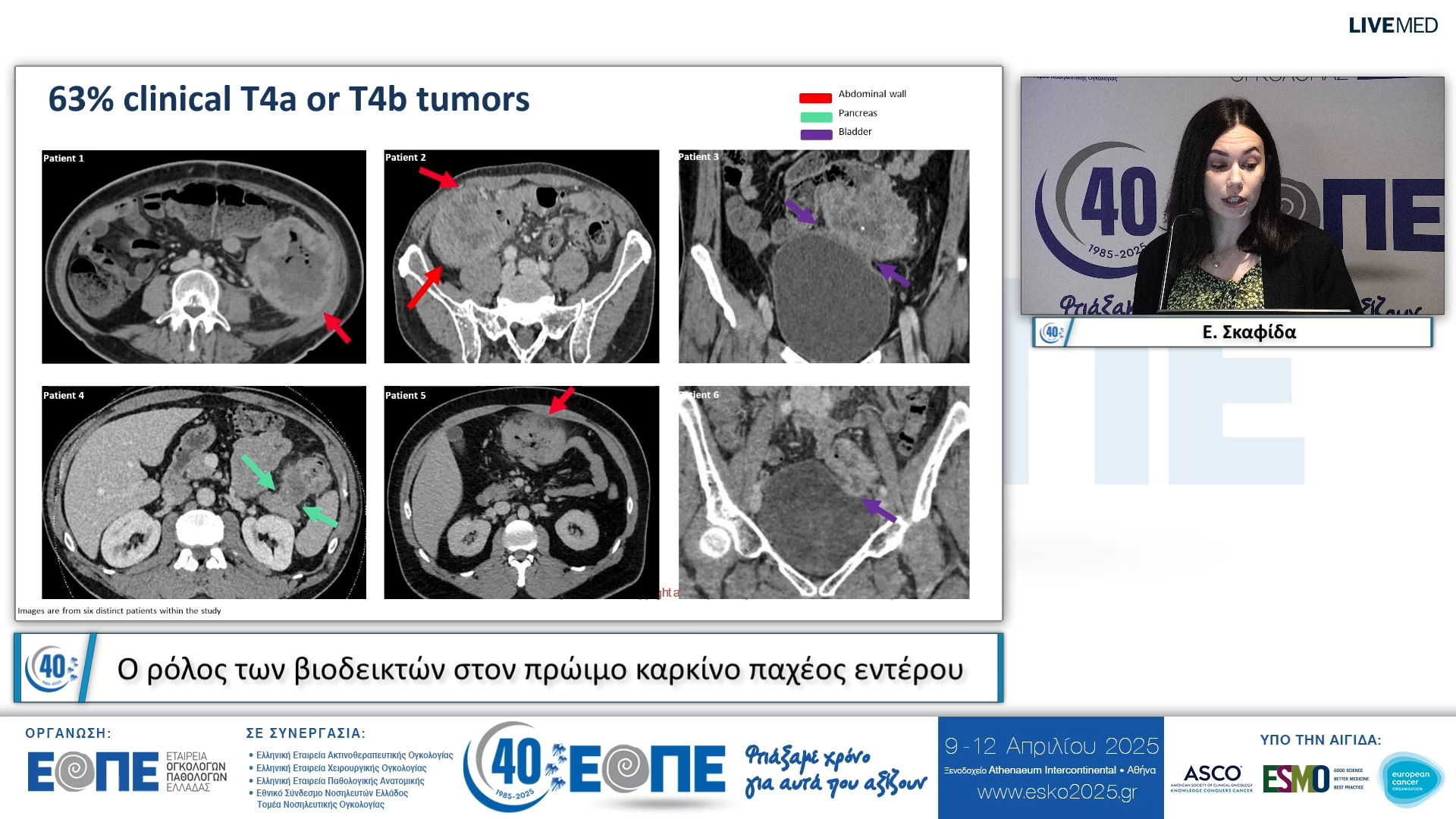 047 Ε. Σκαφίδα - Ο ρόλος των βιοδεικτών στον πρώιμο καρκίνο παχέος εντέρου.