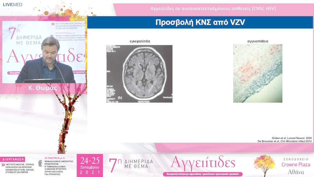 19 Κ. Θωμάς - Αγγειίτιδες σε ανοσοκατεσταλμένους ασθενείς (CMV, HSV)