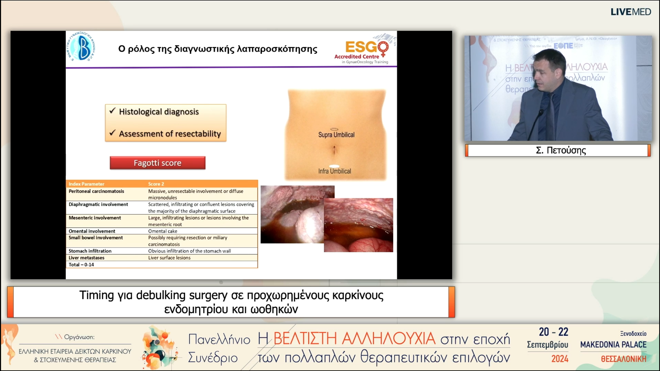 31 Σ. Πετούσης - Timing για debulking surgery σε προχωρημένους καρκίνους ενδομητρίου και ωοθηκών 