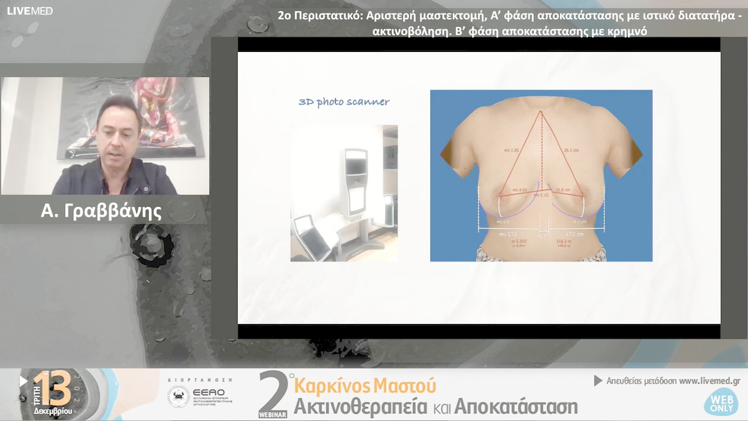 03 Α. Γραββάνης - 2ο Περιστατικό:Αριστερή μαστεκτομή, Α’ φάση αποκατάστασηςμε ιστικό διατατήρα - ακτινοβόληση. Β’ φάση αποκατάστασης με κρημνό.