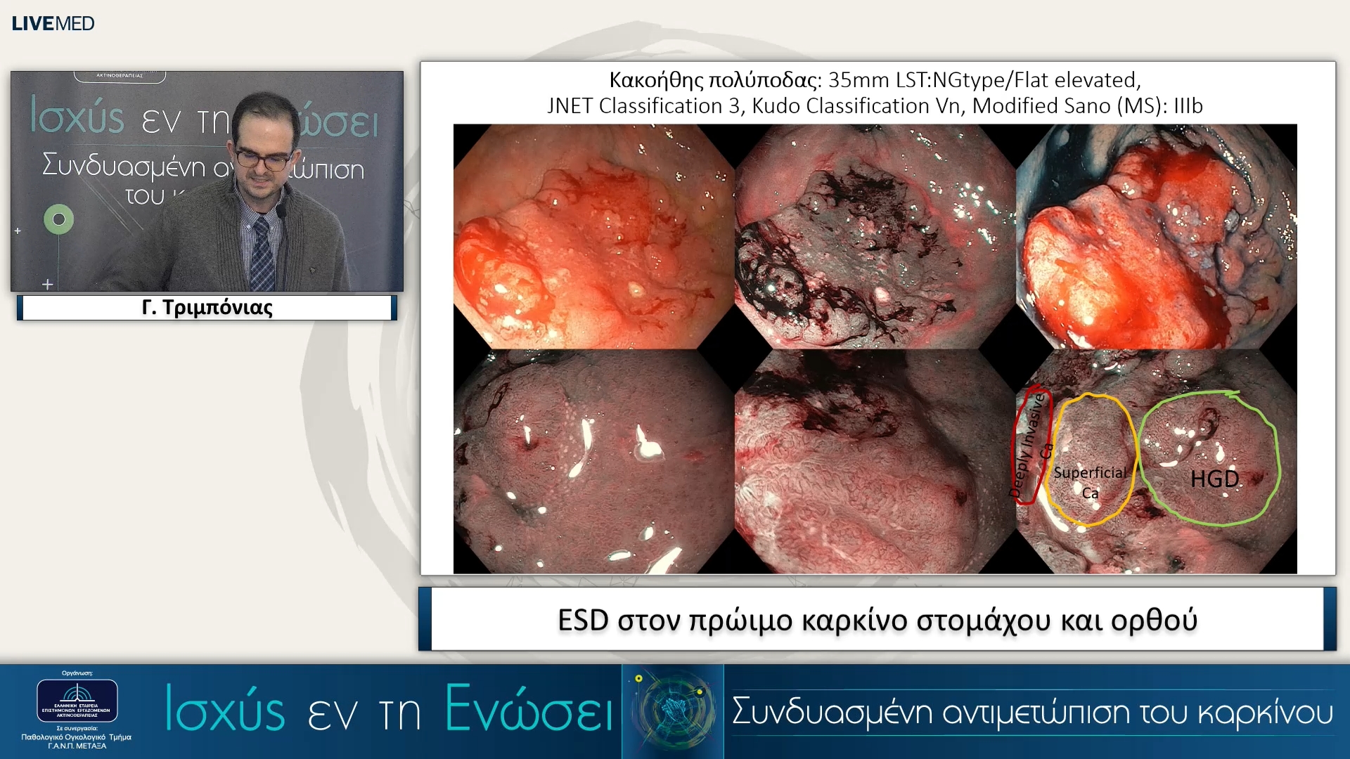 11 Γ. Τριμπόνιας - ESD στον πρώιμο καρκίνο στομάχου και ορθού