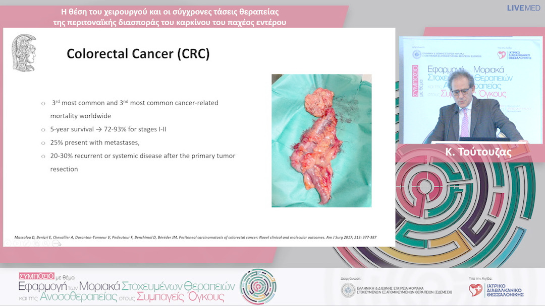 13 Κ. Τούτουζας - Η θέση του χειρουργού και οι σύγχρονες τάσεις θεραπείας της περιτοναϊκής διασποράς του καρκίνου του παχέος εντέρου