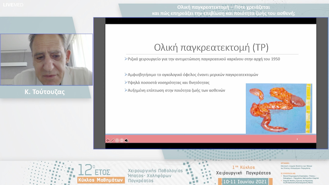 21 Κ. Τούτουζας - Ολική παγκρεατεκτομή – Πότε χρειάζεται και πώς επηρεάζει την επιβίωση και ποιότητα ζωής του ασθενή; 