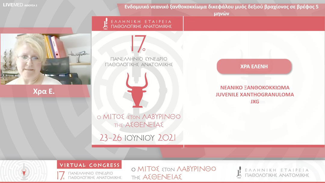 33 Χρά Ε. - Ενδομυικό νεανικό ξανθοκοκκίωμα δικεφάλου μυός δεξιού βραχίονος σε βρέφος 5 μηνών