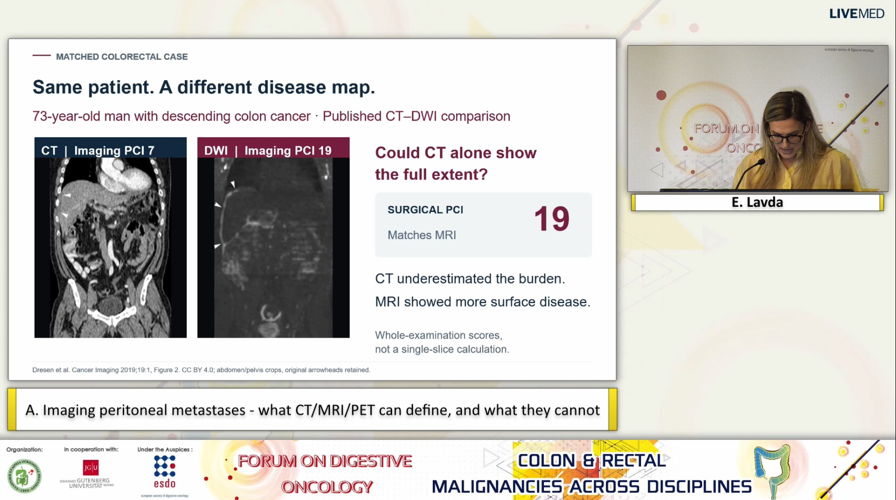 56 E. Lavda - A. Imaging peritoneal metastases - what CT/MRI/PET can define, and what they cannot. 