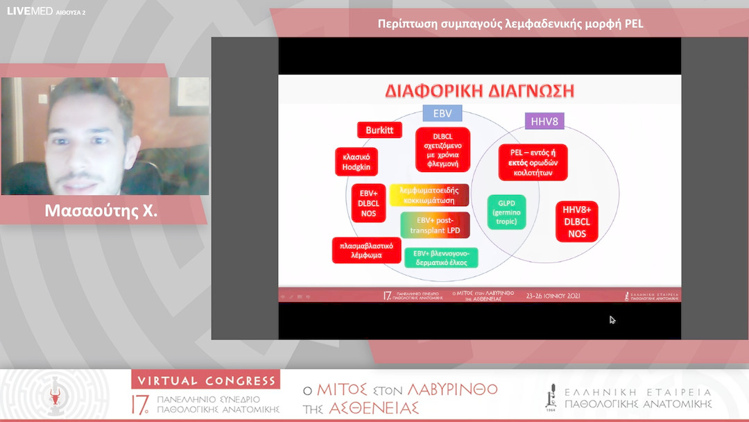 49 Μασαούτης Χ. - Περίπτωση συμπαγούς λεμφαδενικής μορφή PEL 