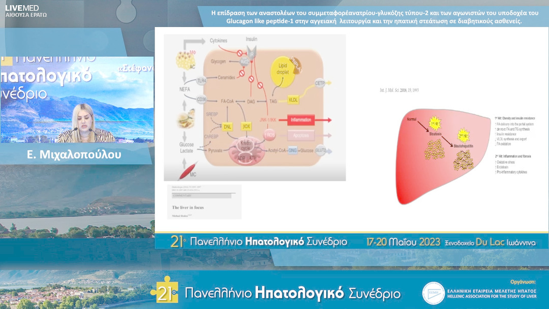 75 Ε. Μιχαλοπούλου - ΕΑ21: Η επίδραση των αναστολέων του συμμεταφορέα νατρίου-γλυκόζης τύπου-2 και των αγωνιστών του υποδοχέα του Glucagon like peptide-1 στην αγγειακή λειτουργία και την ηπατική στεάτωση σε διαβητικούς ασθενείς.