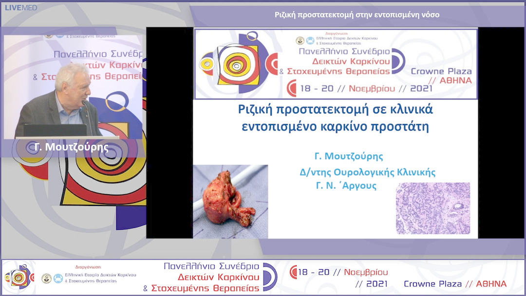 45 Γ. Μουτζούρης - Ριζική προστατεκτομή στην εντοπισμένη νόσο 