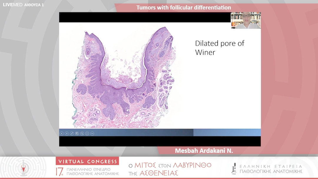 69 Mesbah Ardakani N. - Tumors with follicular differentiation 