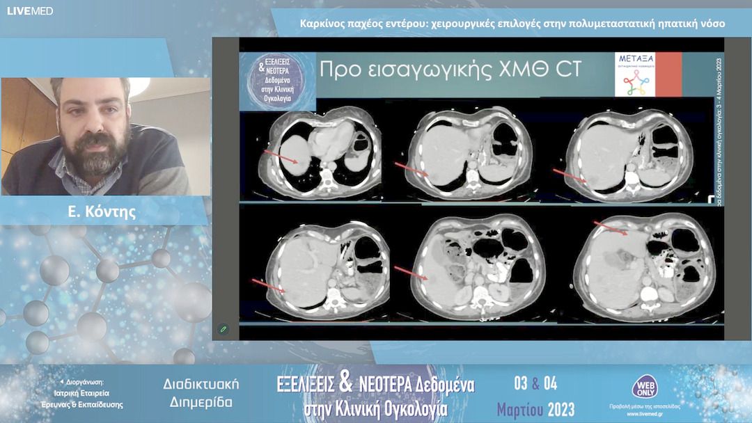 15 Ε. Κόντης - Καρκίνος παχέος εντέρου: χειρουργικές επιλογές στην πολυμεταστατική ηπατική νόσο 