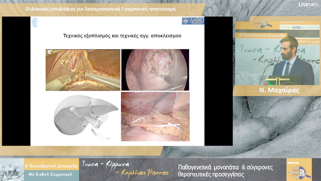 20  Γ. Σωτηρόπουλος - Χειρουργική αντιμετώπιση ασθενούς με ευμέγεθες ΗΚΚ
