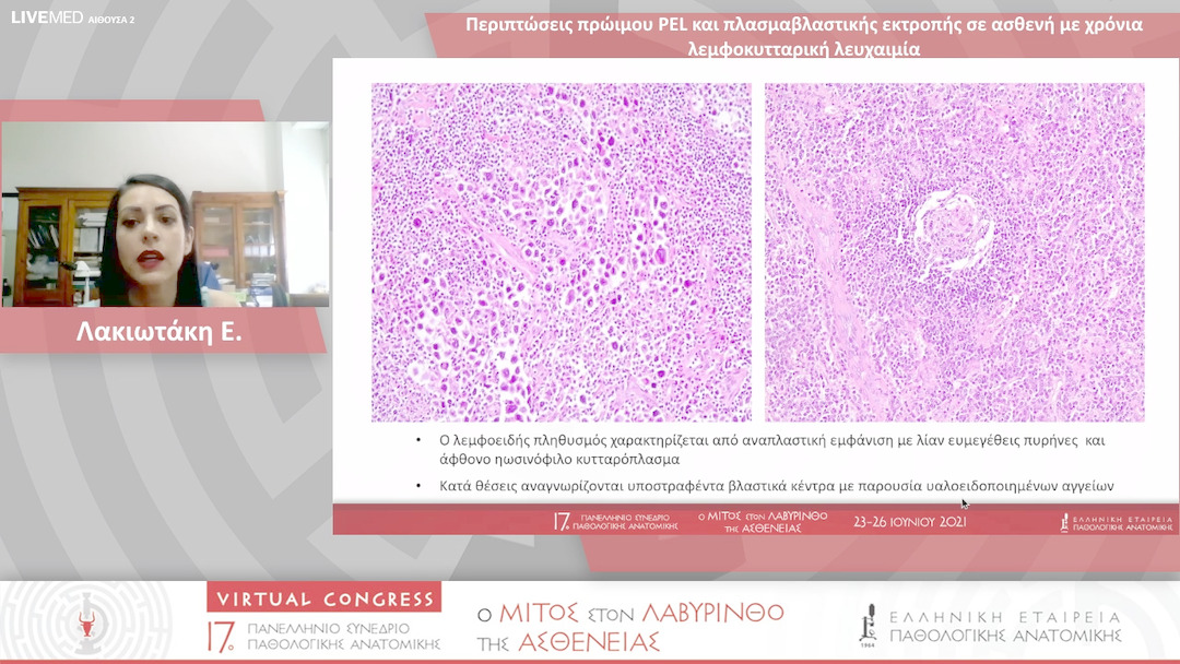 50 Λακιωτάκη Ε. - Περιπτώσεις πρώιμου PEL και πλασμαβλαστικής εκτροπής σε ασθενή με χρόνια λεμφοκυτταρική λευχαιμία 
