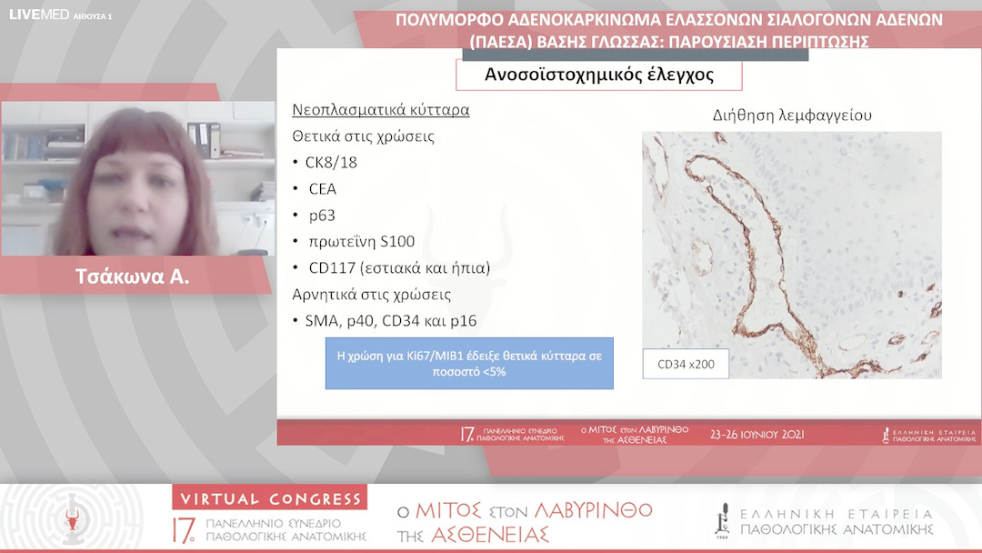 87 Τσάκωνα Α. - ΠΟΛΥΜΟΡΦΟ ΑΔΕΝΟΚΑΡΚΙΝΩΜΑ ΕΛΑΣΣΟΝΩΝ ΣΙΑΛΟΓΟΝΩΝ ΑΔΕΝΩΝ (ΠΑΕΣΑ) ΒΑΣΗΣ ΓΛΩΣΣΑΣ: ΠΑΡΟΥΣΙΑΣΗ ΠΕΡΙΠΤΩΣΗΣ