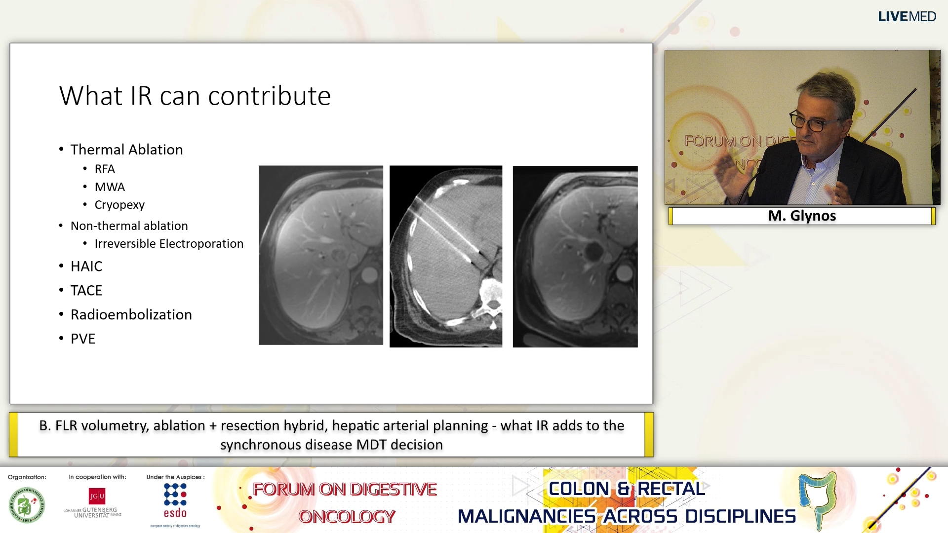 62 M. Glynos - B. FLR volumetry, ablation + resection hybrid, hepatic arterial planning - what IR adds to the synchronous disease MDT decision.