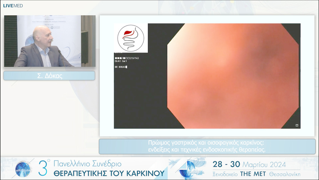 13 Σ. Δόκας - Πρώιμος γαστρικός και οισοφαγικός καρκίνος: ενδείξεις και τεχνικές ενδοσκοπικής θεραπείας. 