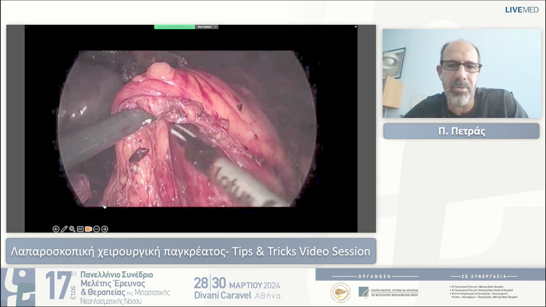 20 Π. Πετράς - Λαπαροσκοπική χειρουργική παγκρέατος- Tips & Tricks Video Session 