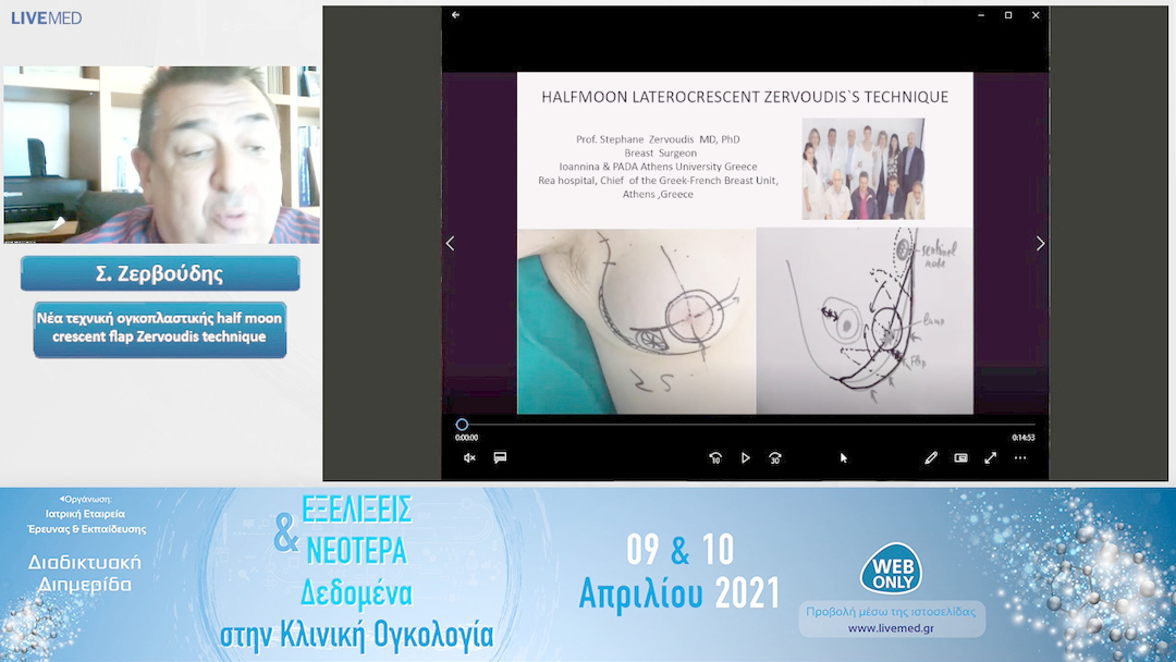 27 Σ. Ζερβούδης - Νέα τεχνική ογκοπλαστικής half moon crescent flap Zervoudis technique 