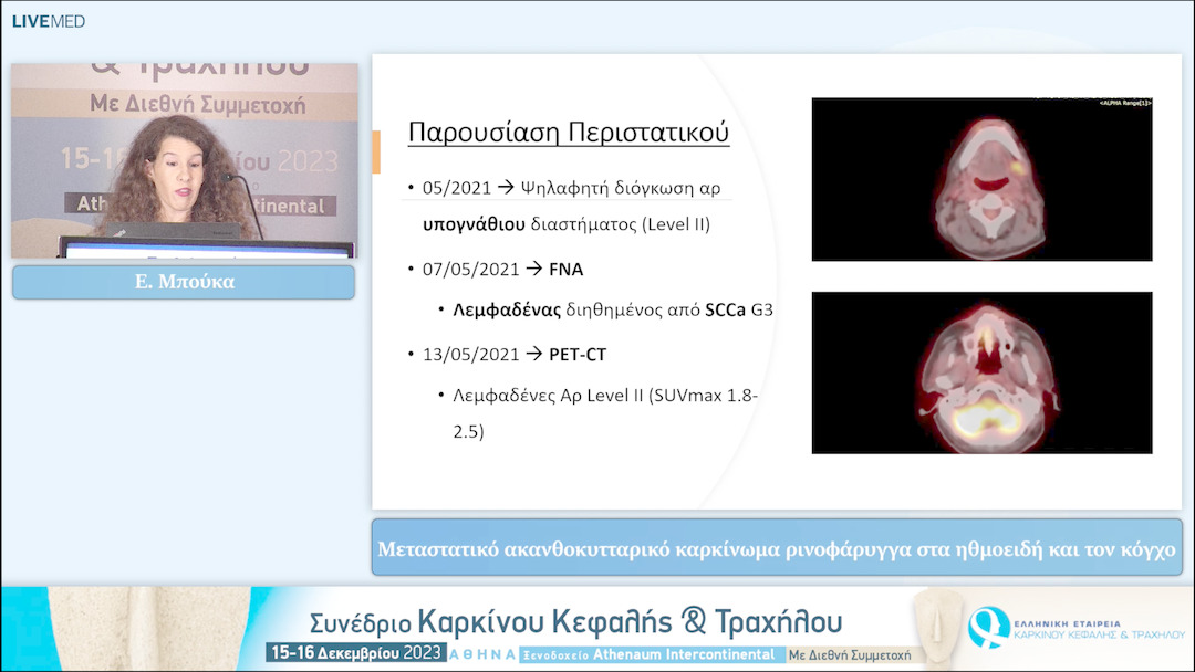 11 Ε. Μπούκα - Μεταστατικό ακανθοκυτταρικό καρκίνωμα ρινοφάρυγγα στα ηθμοειδή και τον κόγχο 