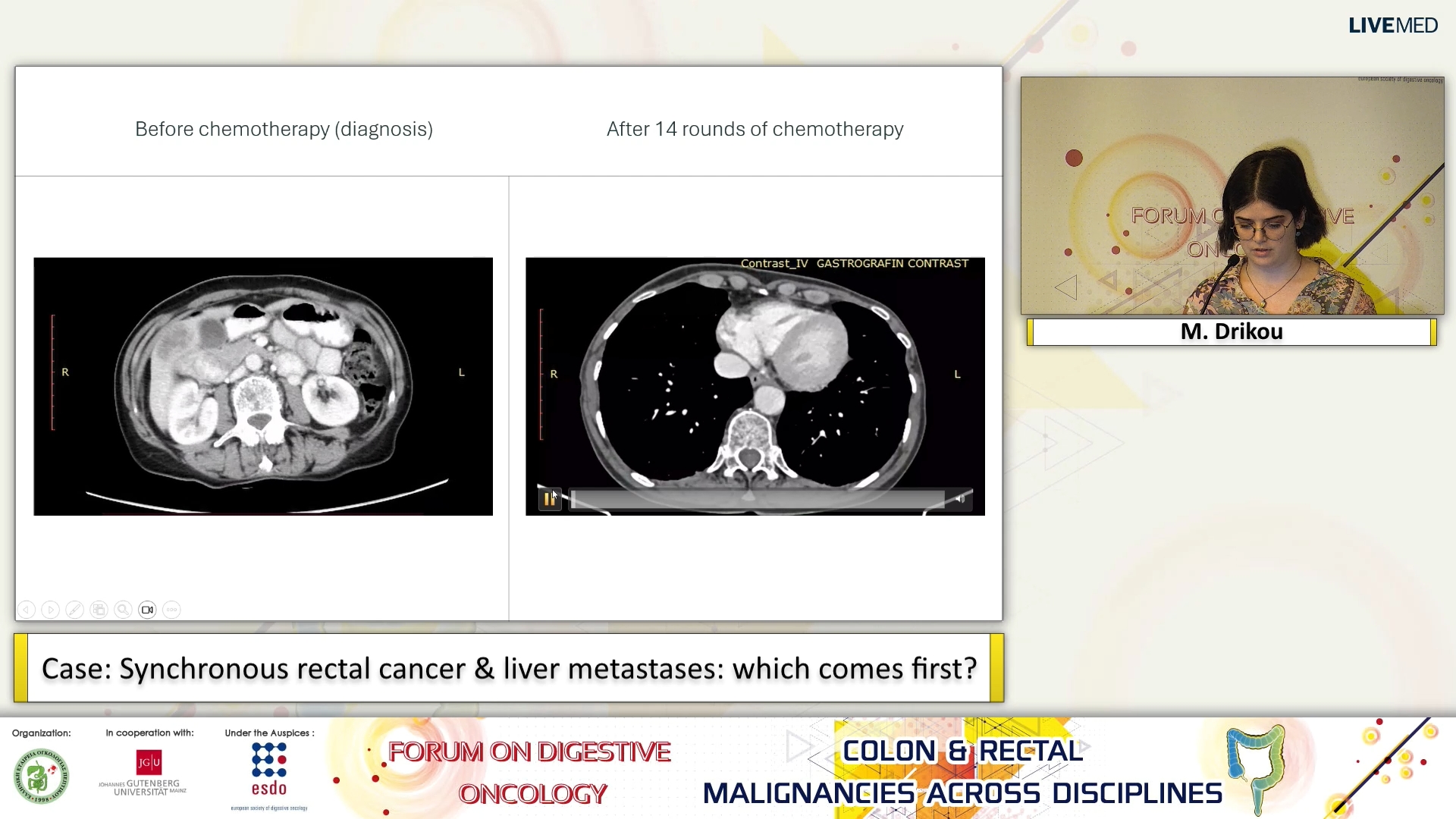 60  M. Drikou - Case: Synchronous rectal cancer & liver metastases: which comes first?