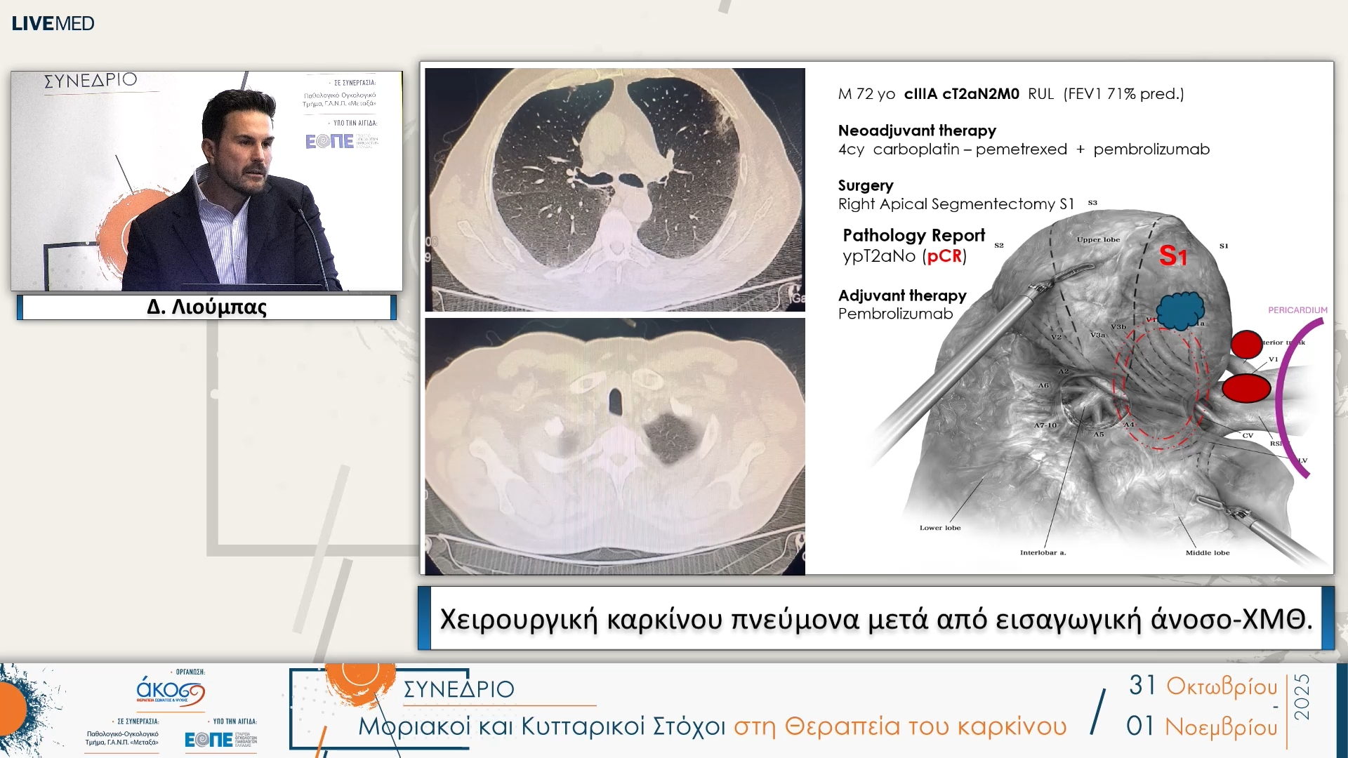 23 Δ. Λιούμπας - Χειρουργική καρκίνου πνεύμονα μετά από εισαγωγική άνοσο-ΧΜΘ.