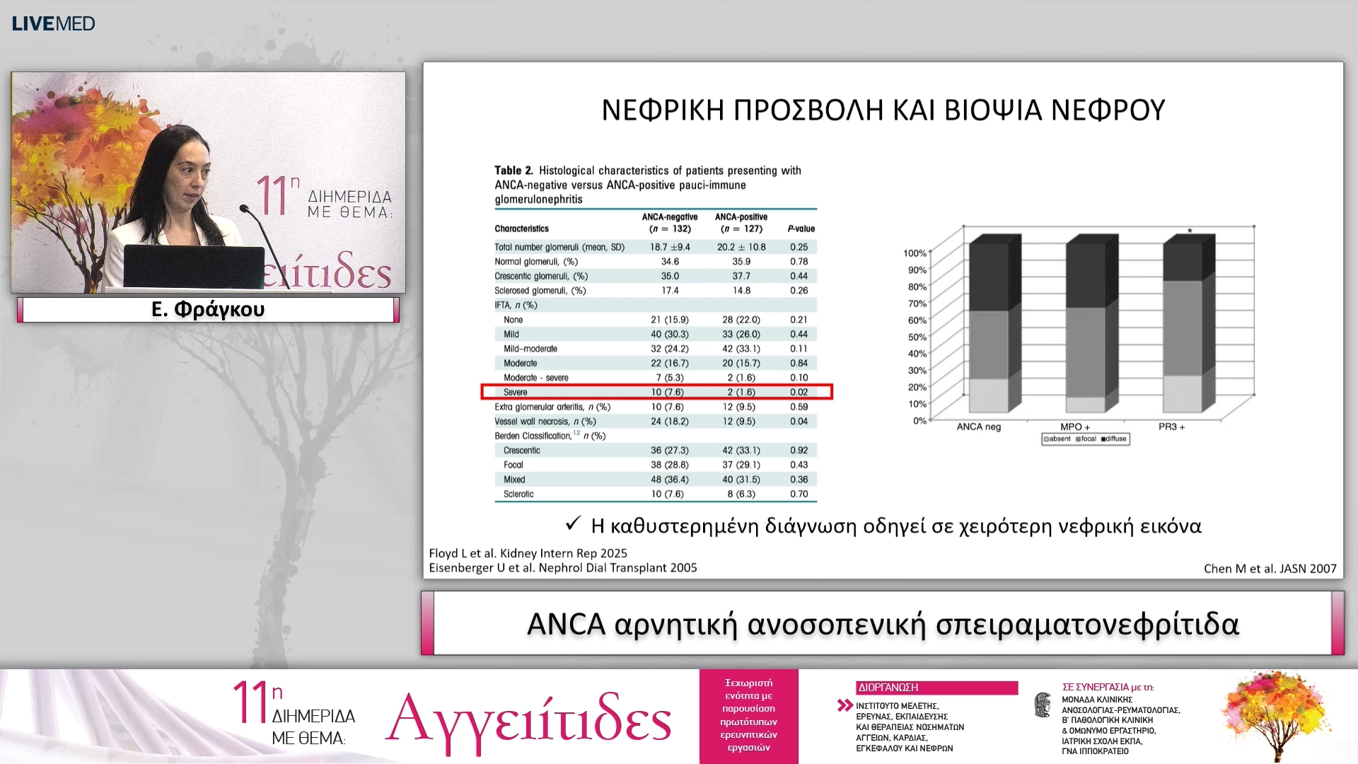 26 Ε. Φράγκου - ANCA αρνητική ανοσοπενική σπειραματονεφρίτιδα