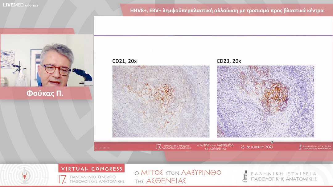 48 Φούκας Π. - HHV8+, EBV+ λεμφοϋπερπλαστική αλλοίωση με τροπισμό προς βλαστικά κέντρα 