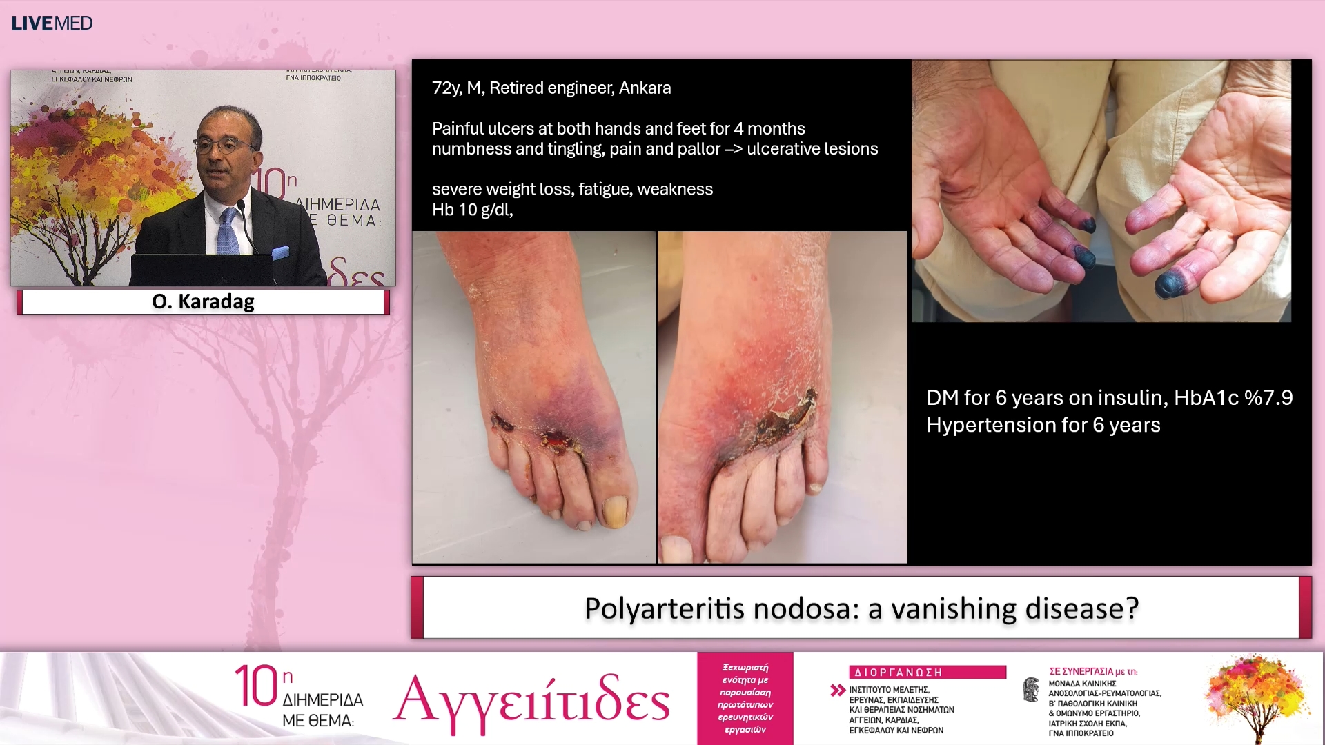16 O. Karadag - Polyarteritis nodosa: a vanishing disease? 