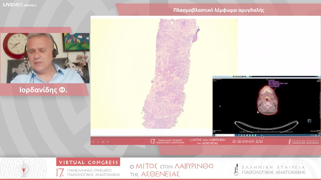46 Ιορδανίδης Φ. - Πλασμαβλαστικό λέμφωμα αμυγδαλής