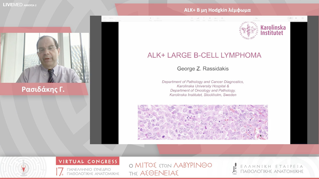 51 Ρασιδάκης Γ. - ALK+ B μη Hodgkin λέμφωμα