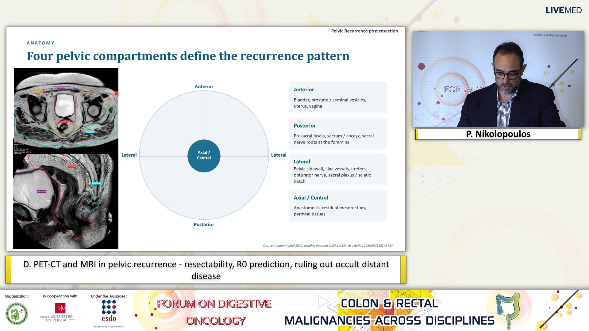 52 P. Nikolopoulos - D. PET-CT and MRI in pelvic recurrence - resectability, R0 prediction, ruling out occult distant disease. 