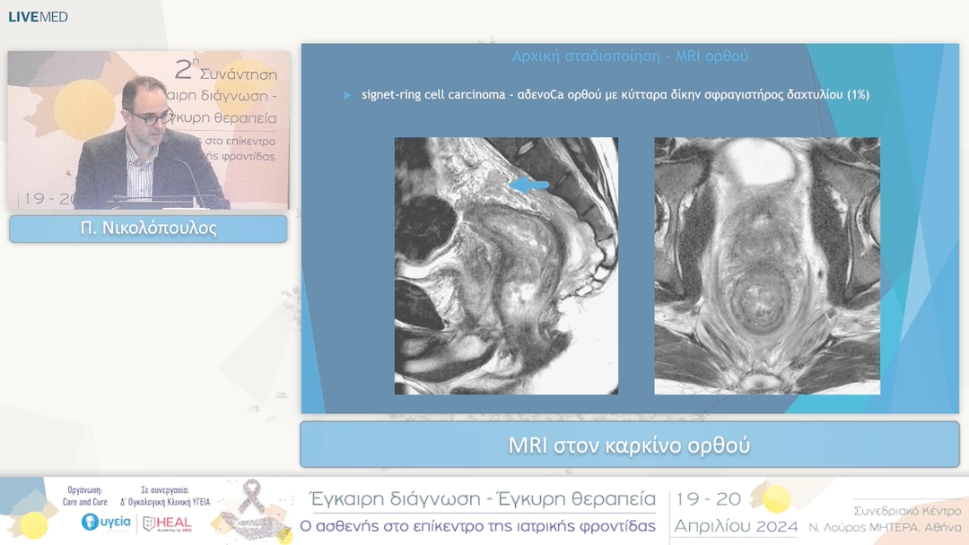 26 Π. Νικολόπουλος - MRI στον καρκίνο ορθού 