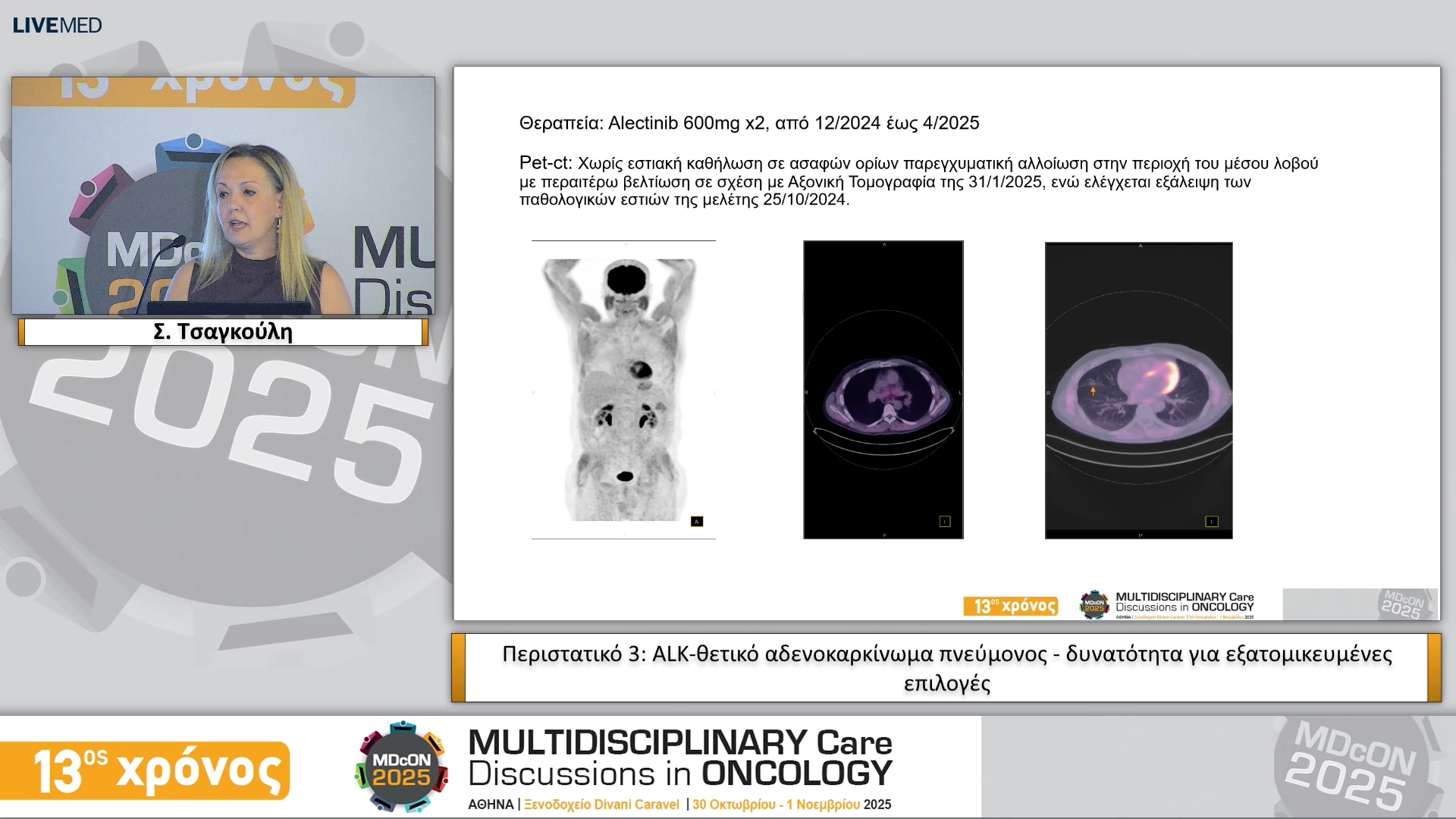 13 Σ. Τσαγκούλη • Περιστατικό 3: ALK-θετικό αδενοκαρκίνωμα πνεύμονος - δυνατότητα για εξατομικευμένες επιλογές 