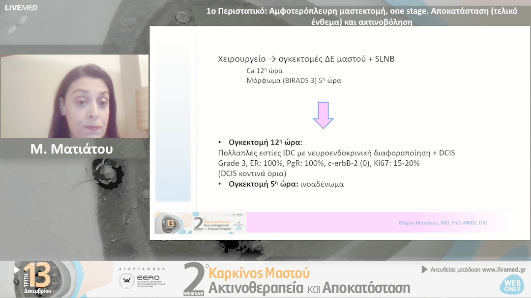 02 Μ. Ματιάτου - 1ο Περιστατικό: Αμφοτερόπλευρη μαστεκτομή, one stage. Αποκατάσταση (τελικό ένθεμα) και ακτινοβόληση