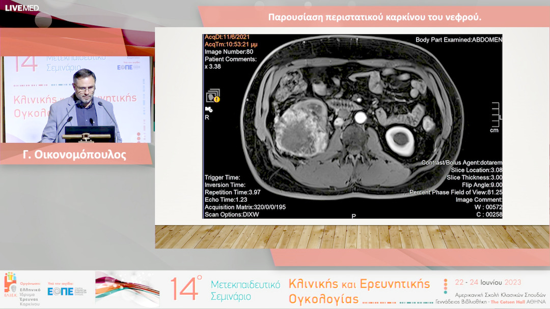 10 Γ. Οικονομόπουλος - Παρουσίαση περιστατικού καρκίνου του νεφρού.