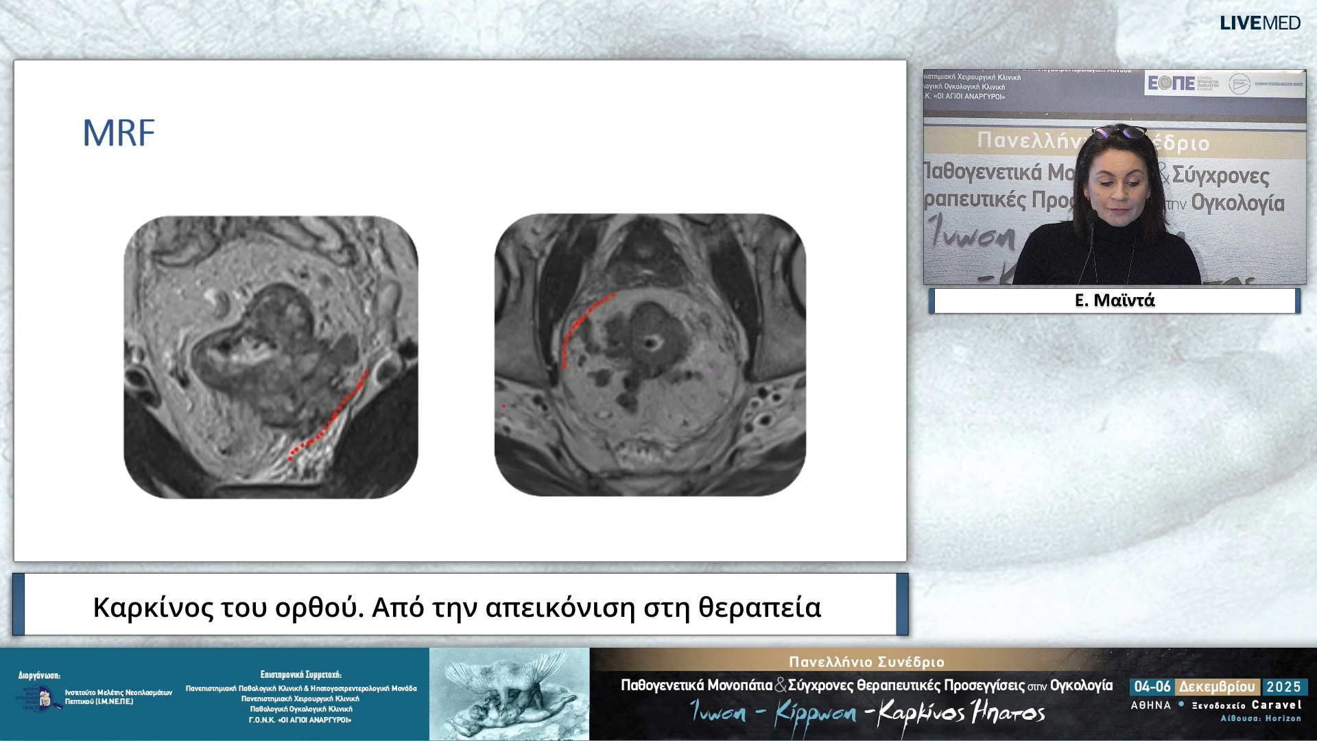 20 Ε. Μαϊντά - Καρκίνος του ορθού. Από την απεικόνιση στη θεραπεία
