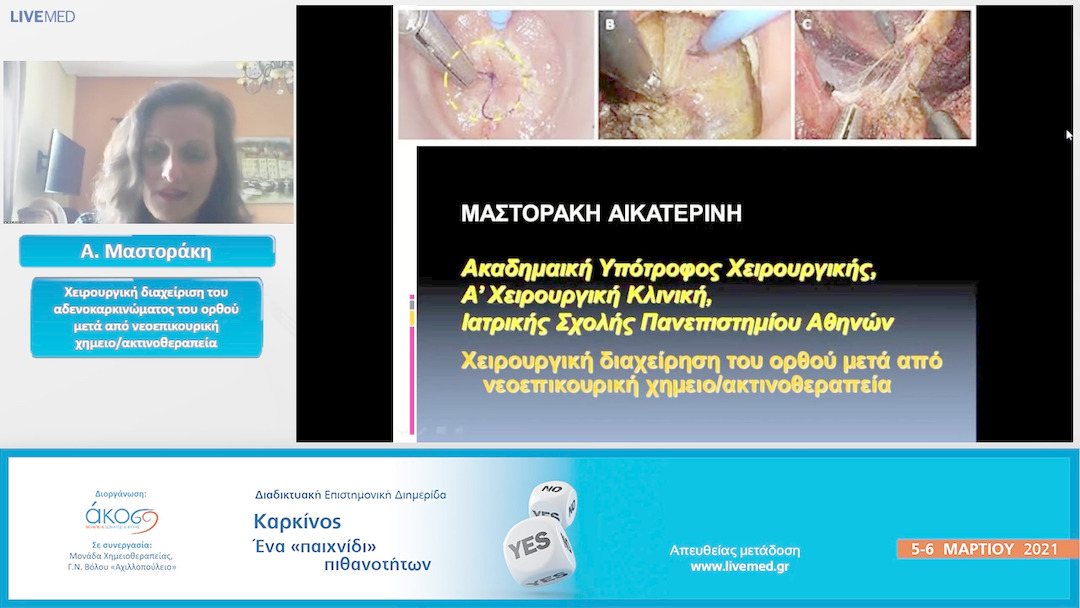 38 Α. Μαστοράκη - Χειρουργική διαχείριση του αδενοκαρκινώματος του ορθού μετά από νεοεπικουρική χημειο/ακτινοθεραπεία