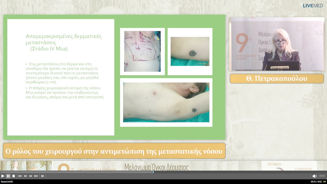 13 Θ. Πετρακοπούλου - Ο ρόλος του χειρουργού στην αντιμετώπιση της μεταστατικής νόσου 
