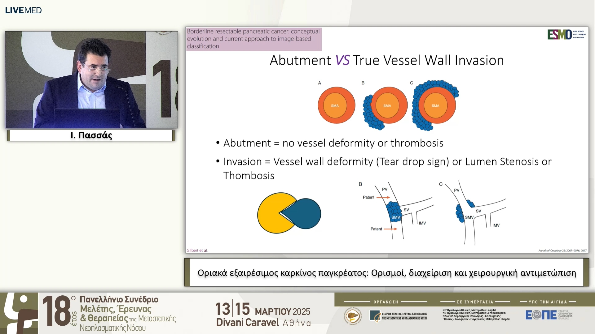 02 Ι. Πασσάς - Οριακά εξαιρέσιμος καρκίνος παγκρέατος: Ορισμοί, διαχείριση και χειρουργική αντιμετώπιση.