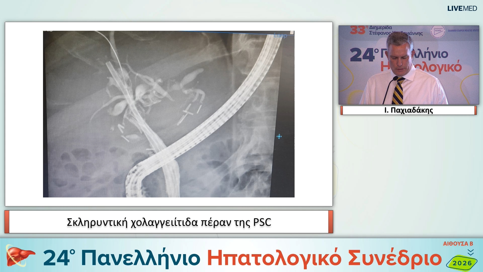 04 I. Παχιαδάκης - Σκληρυντική χολαγγειίτιδα πέραν της PSC