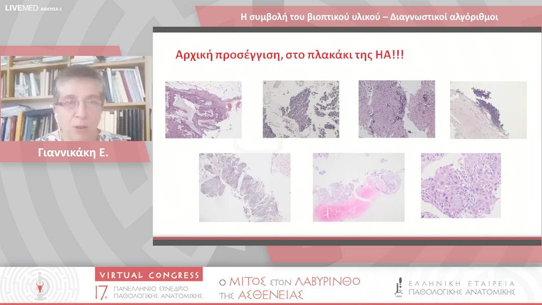 51 Γιαννικάκη E. - Η συμβολή του βιοπτικού υλικού – Διαγνωστικοί αλγόριθμοι 